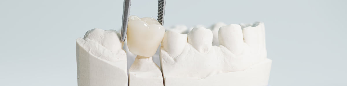 Dental Crown