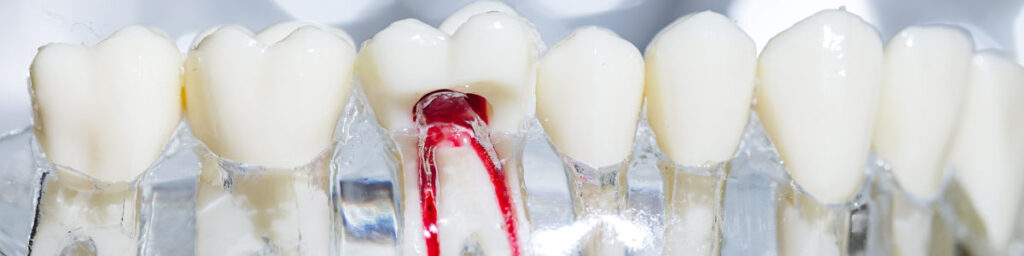 Root Canal