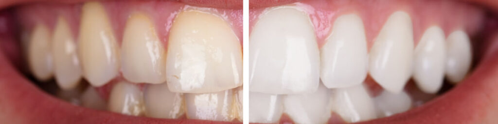 Teeth Whitening