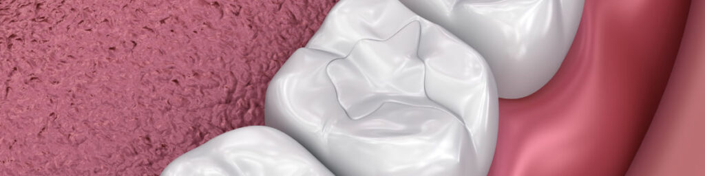 Tooth-colored Dental Fillings